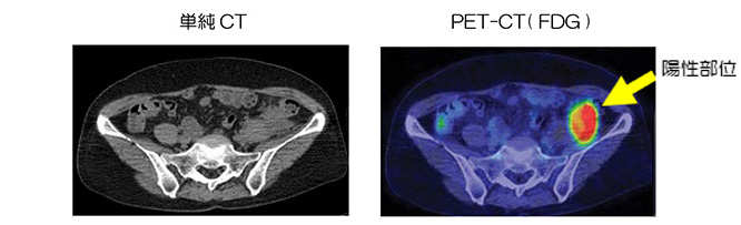 FDG-PETイメージ